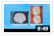 Basic Screening Survey Video for Non-Dental Professional 2 of 3